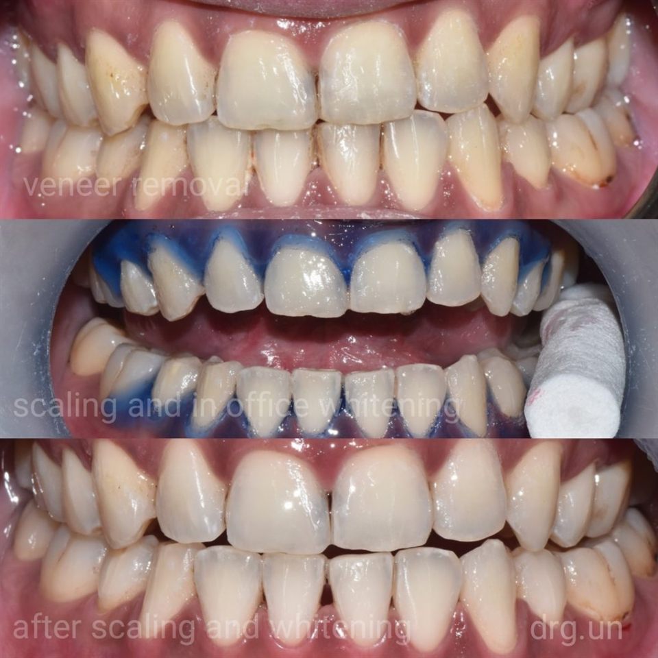 Bleaching Gigi hasil 2