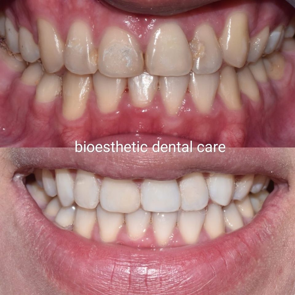 Bleaching Gigi hasil 3