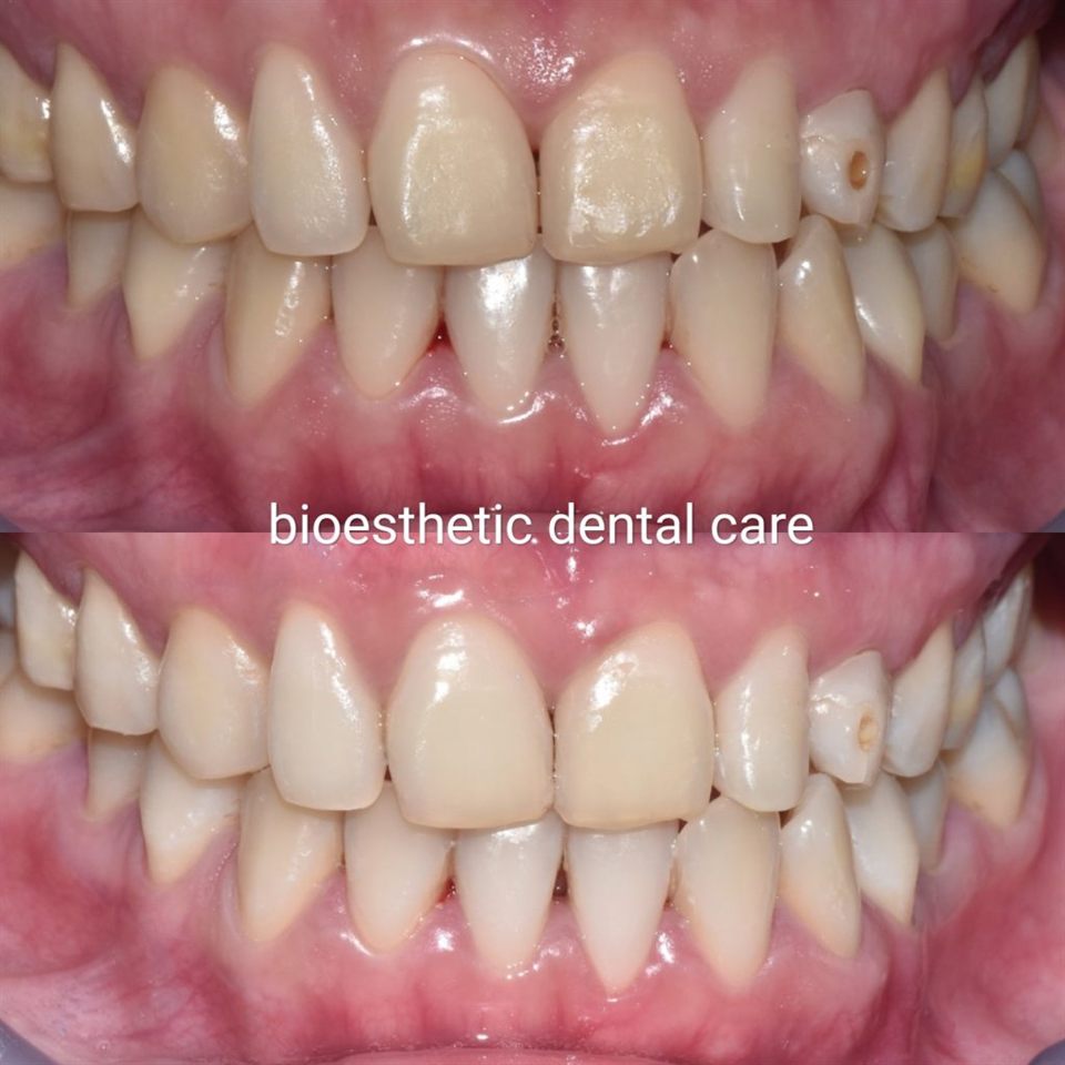 Bleaching Gigi hasil 4