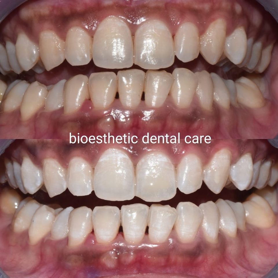 Bleaching Gigi hasil 5