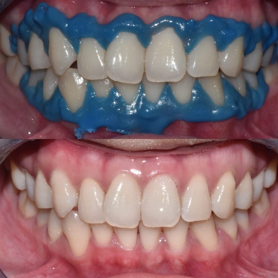 Bleaching Gigi hasil 6