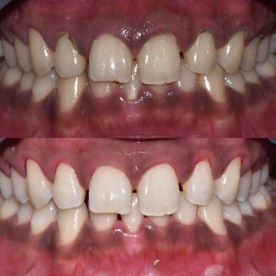 Bleaching Gigi hasil 7