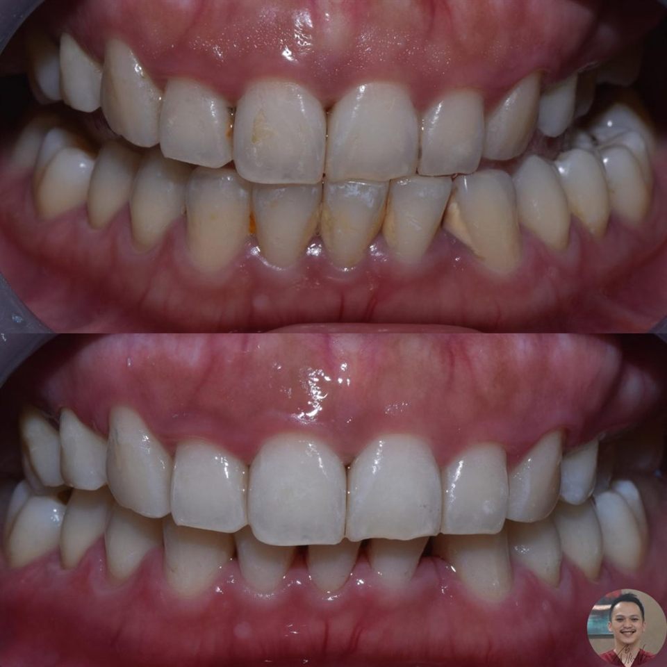 Bleaching Gigi hasil 8