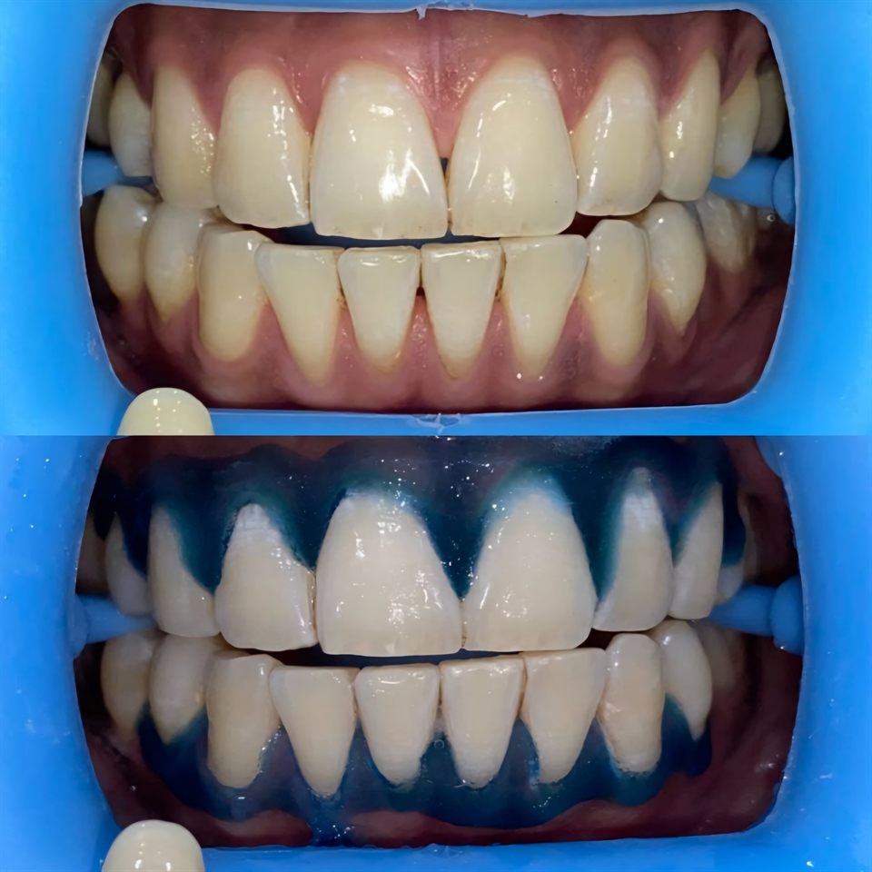 Bleaching Gigi hasil 9