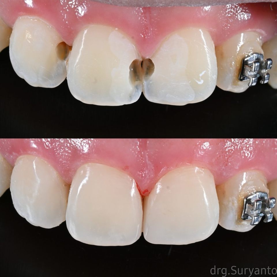 Perawatan Saluran Akar katalog 4