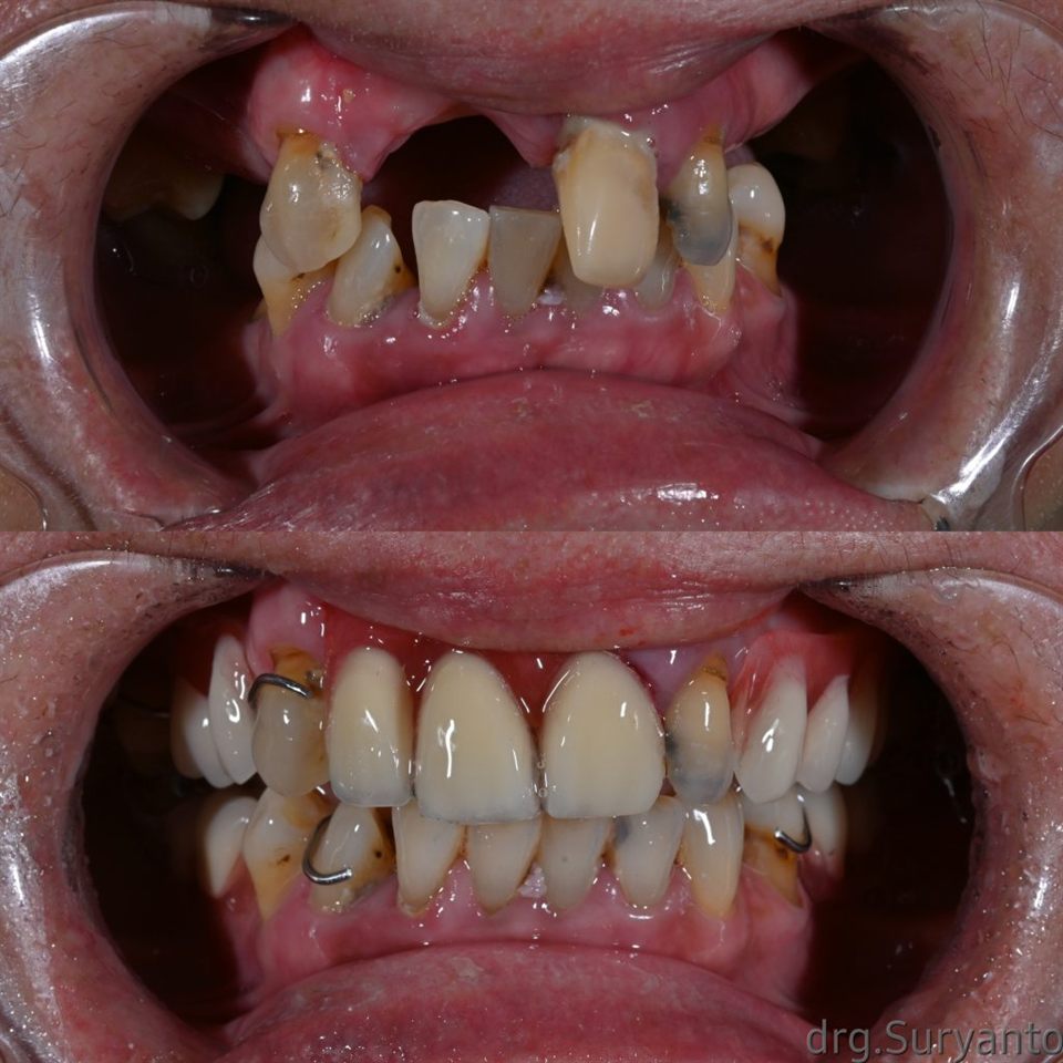 Gigi Palsu katalog 9