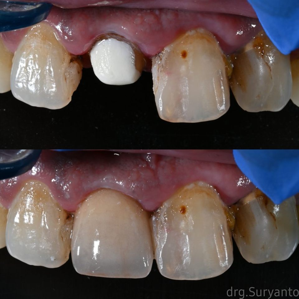 Gigi Palsu katalog 11