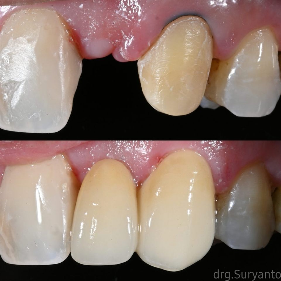 Gigi Palsu katalog 13