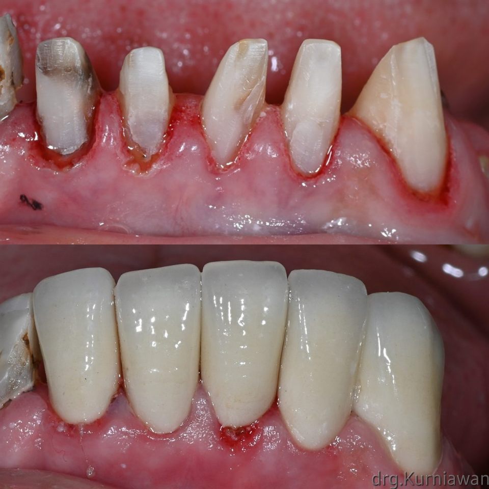 Gigi Palsu katalog 14