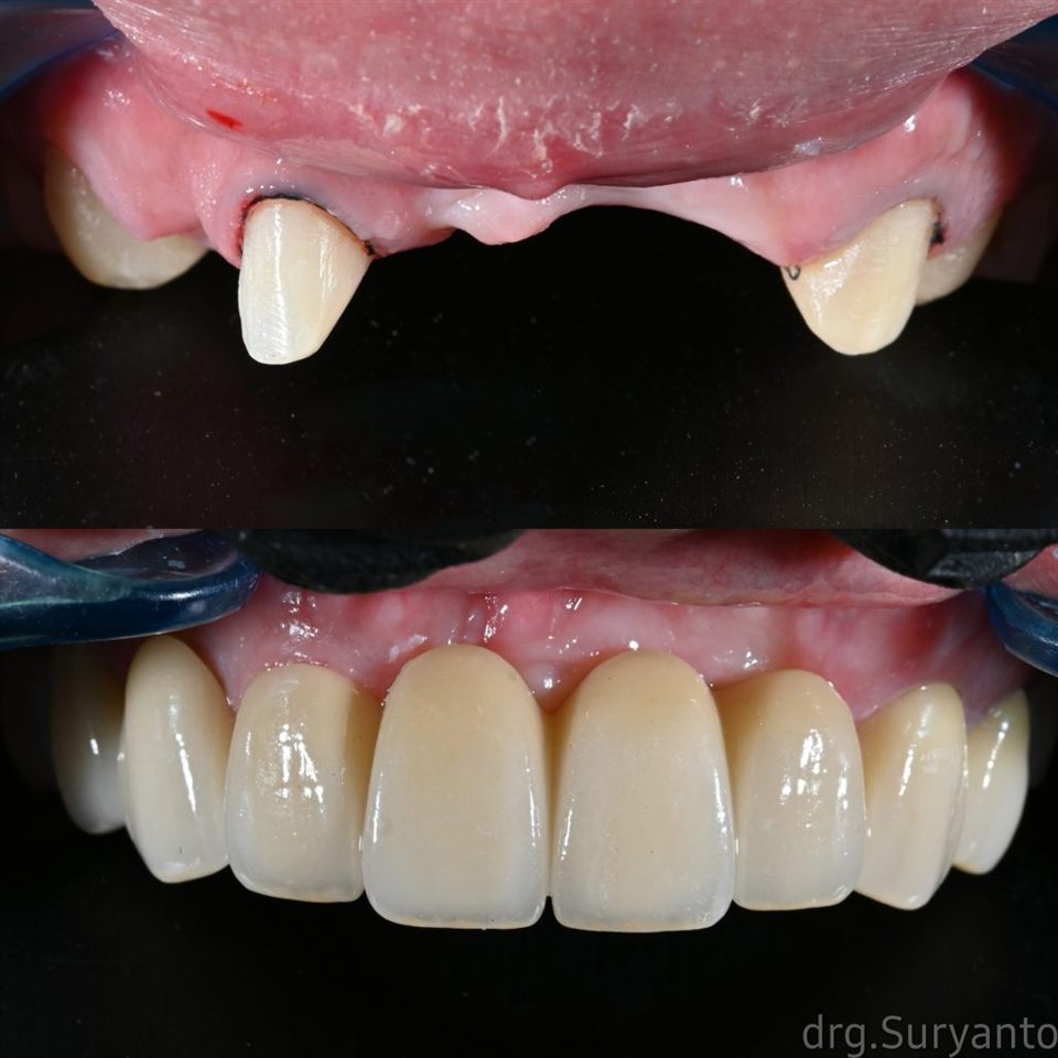 Gigi Palsu katalog 16