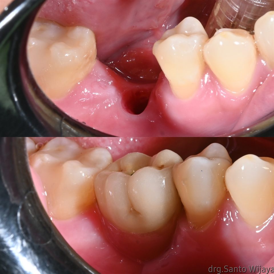 Implan Gigi hasil 2