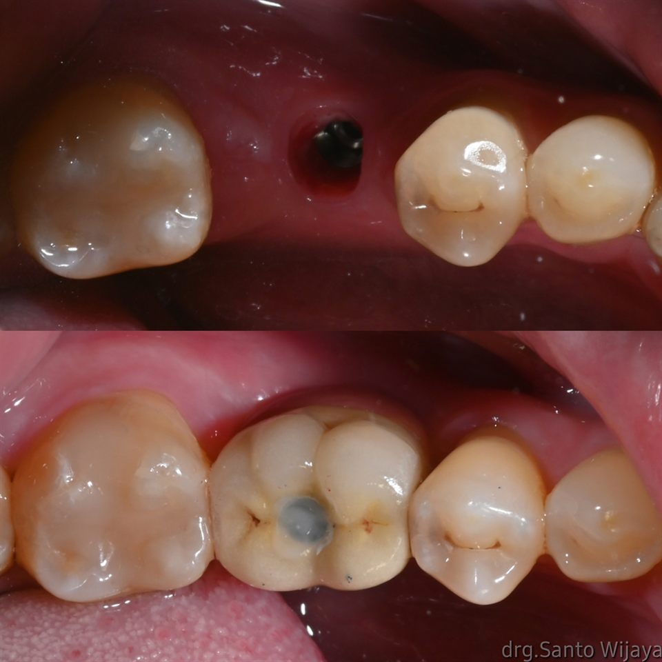 Implan Gigi hasil 3