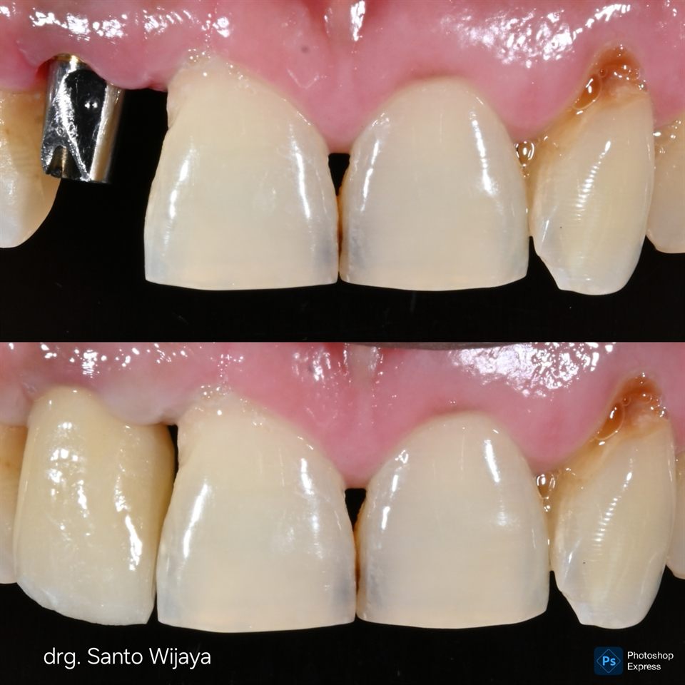 Implan Gigi hasil 7