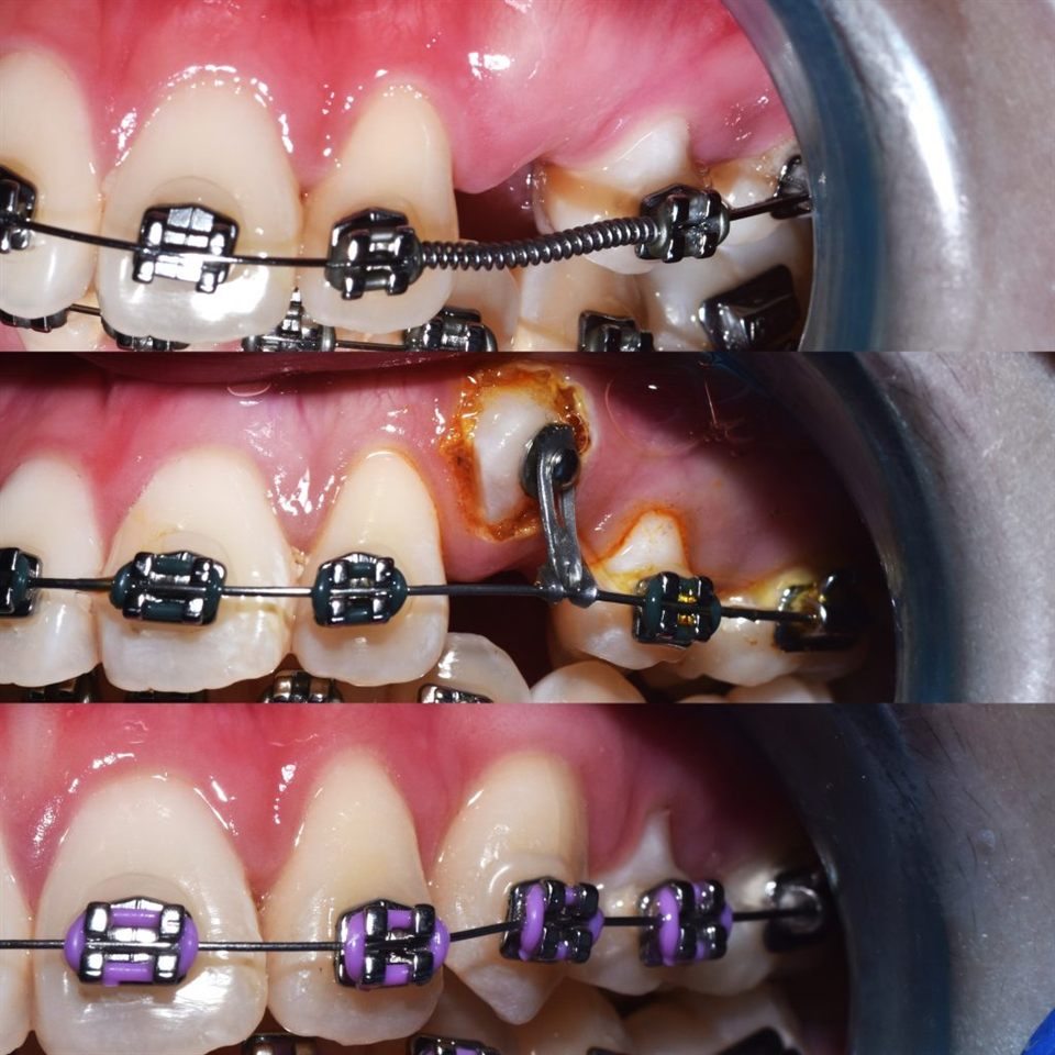 Invisalign katalog 1