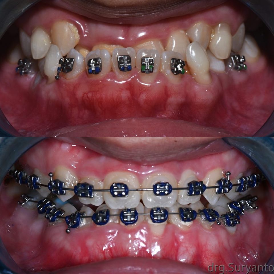 Invisalign katalog 3