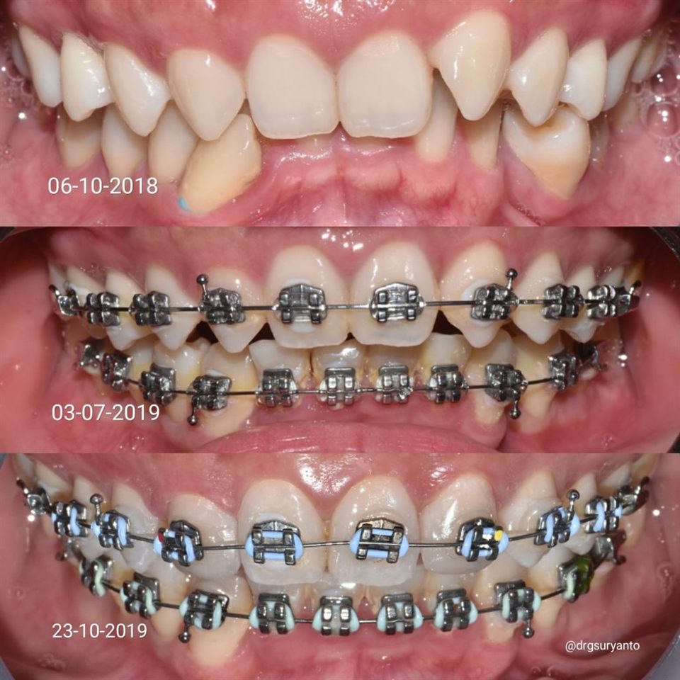 Kawat Gigi (Behel) hasil 1