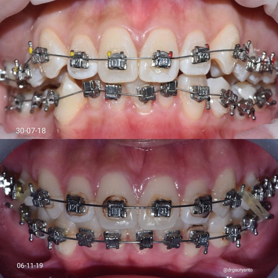 Kawat Gigi (Behel) hasil 2