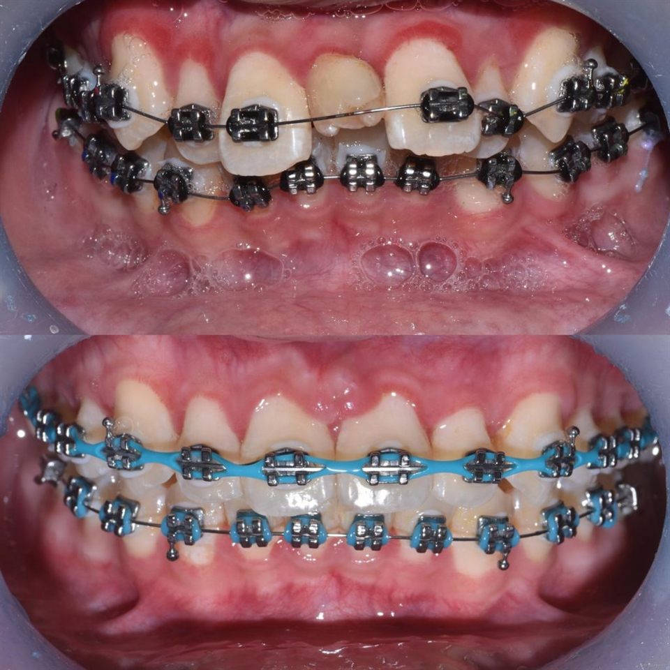 Kawat Gigi (Behel) hasil 3