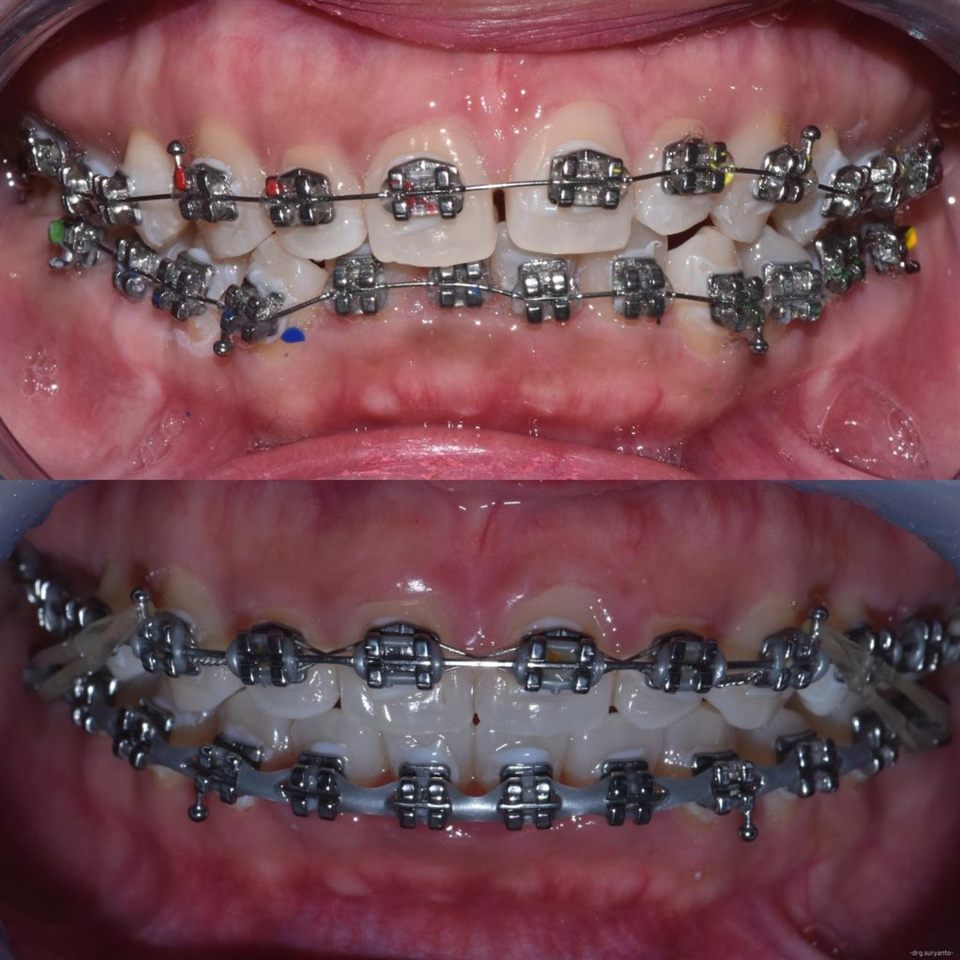 Kawat Gigi (Behel) hasil 4