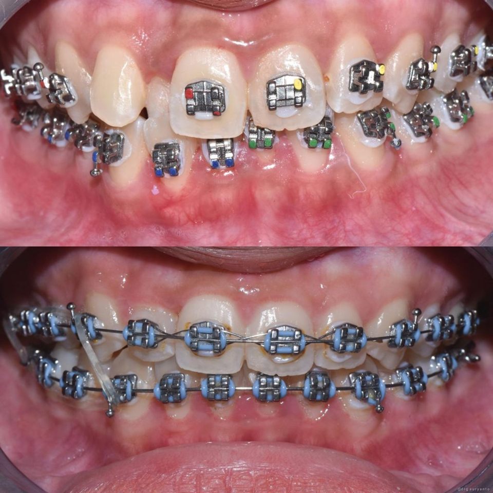 Kawat Gigi (Behel) hasil 5