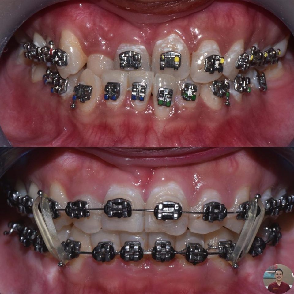 Kawat Gigi (Behel) hasil 6