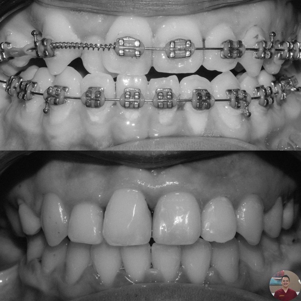 Kawat Gigi (Behel) hasil 7