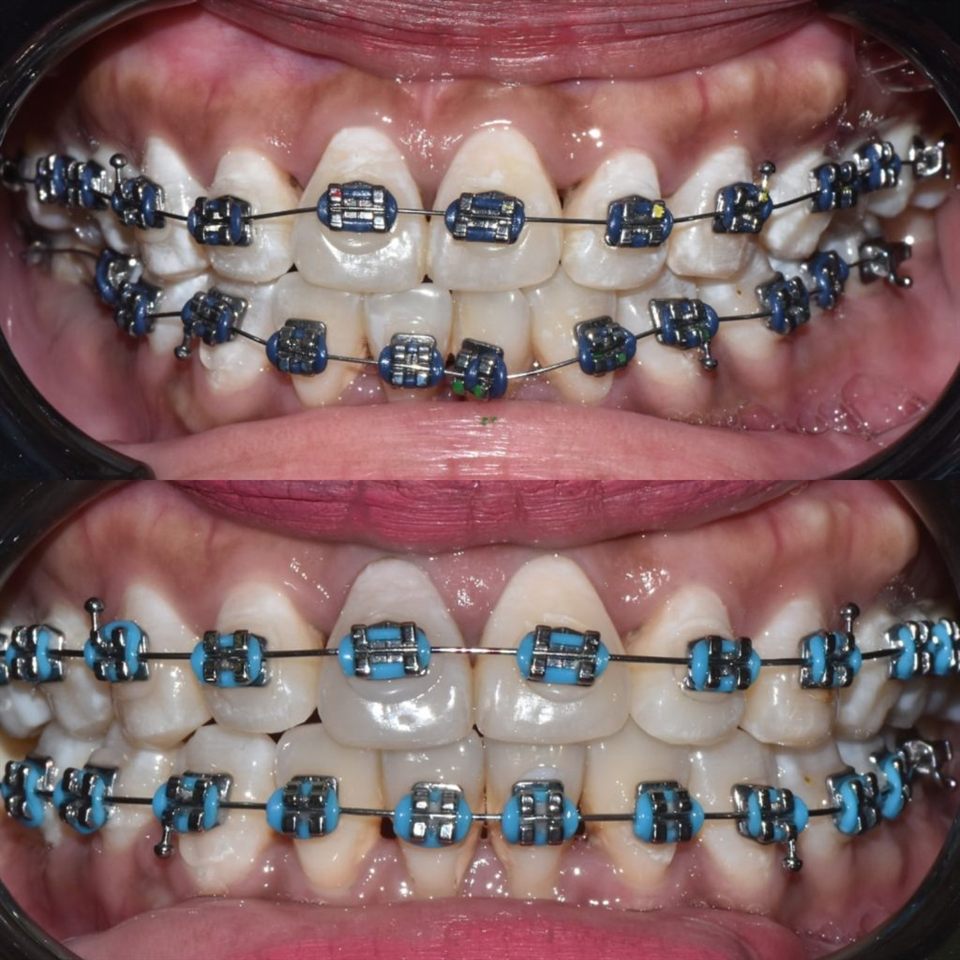 Kawat Gigi (Behel) hasil 8