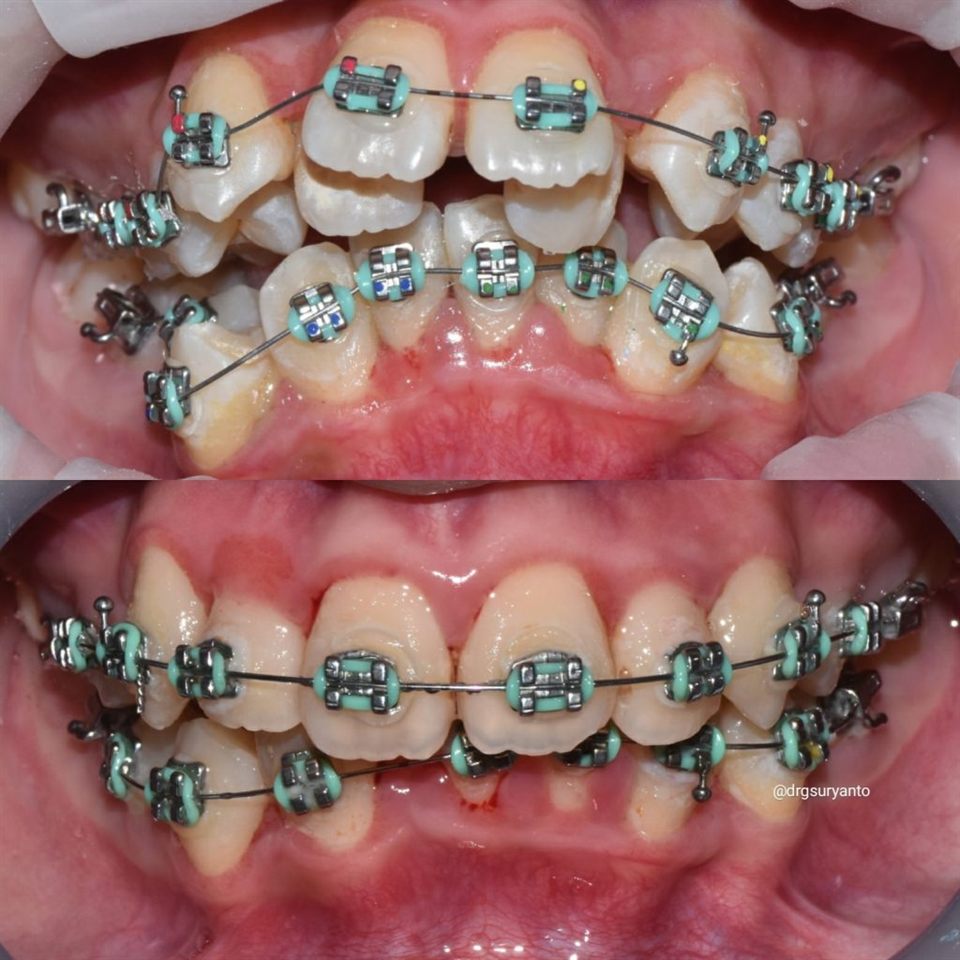 Kawat Gigi (Behel) hasil 9