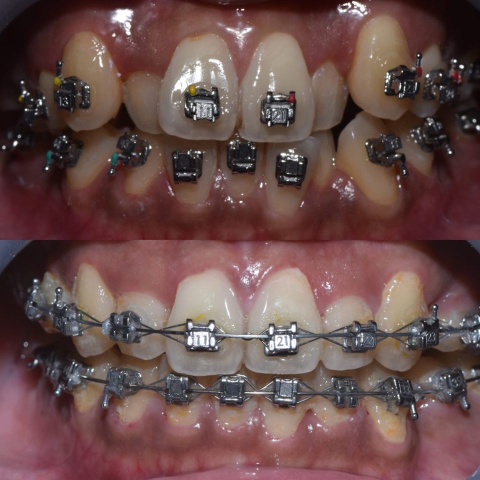 Kawat Gigi (Behel) hasil 10