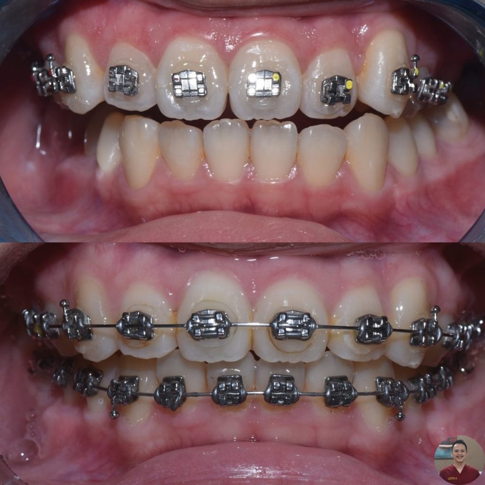 Kawat Gigi (Behel) hasil 13