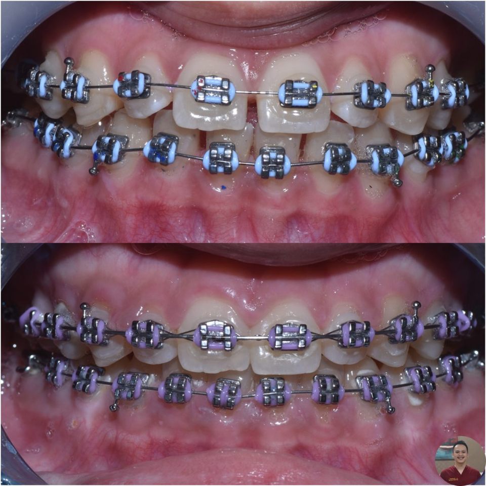 Kawat Gigi (Behel) hasil 14