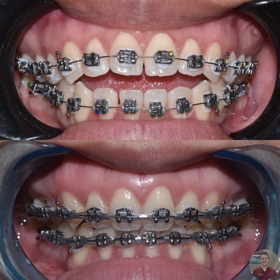 Kawat Gigi (Behel) hasil 15