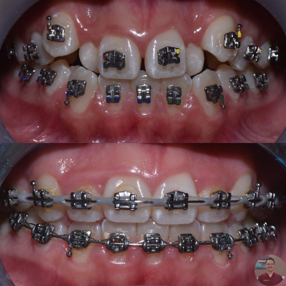 Kawat Gigi (Behel) hasil 16