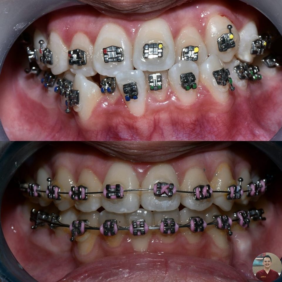 Kawat Gigi (Behel) hasil 17