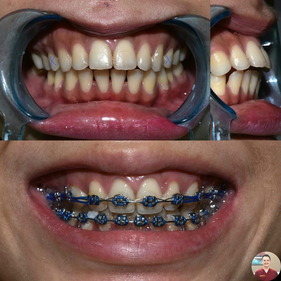 Kawat Gigi (Behel) hasil 18