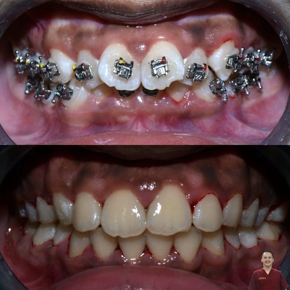 Kawat Gigi (Behel) hasil 19