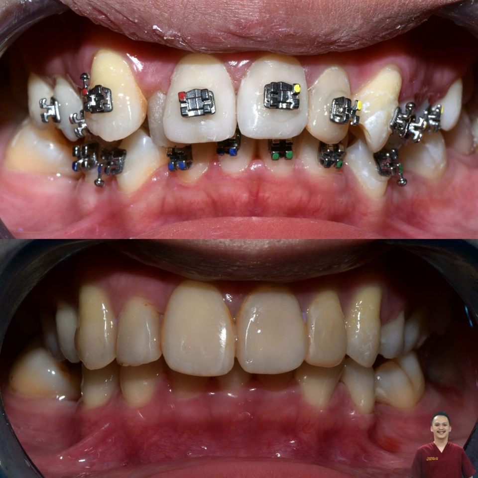 Kawat Gigi (Behel) hasil 20