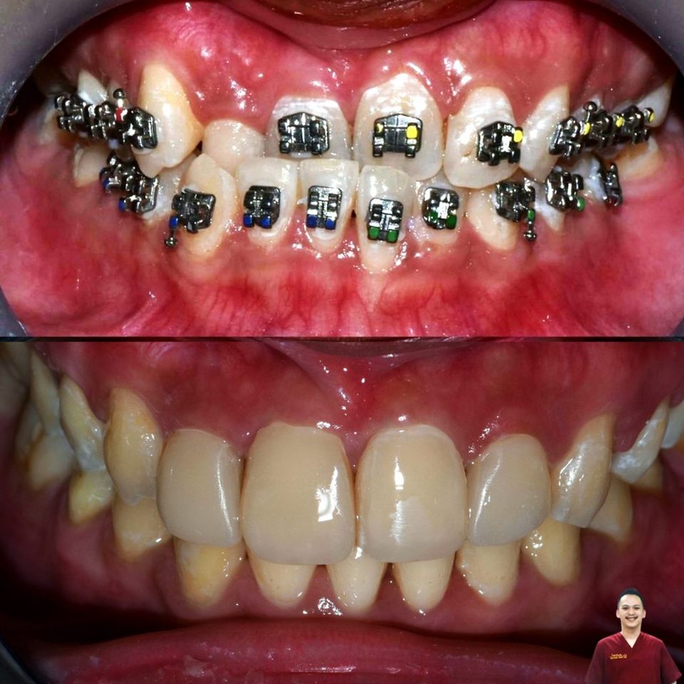 Kawat Gigi (Behel) hasil 21