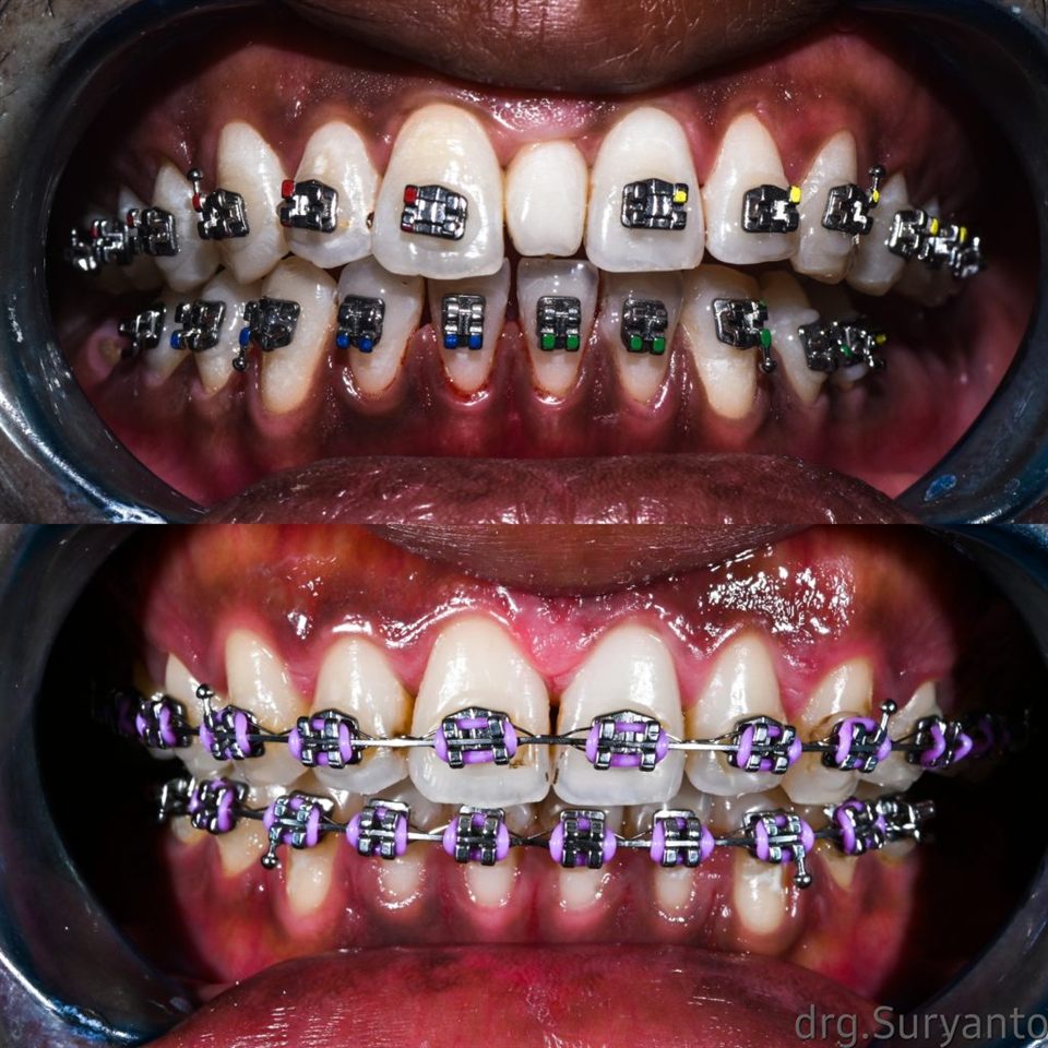 Kawat Gigi (Behel) hasil 25