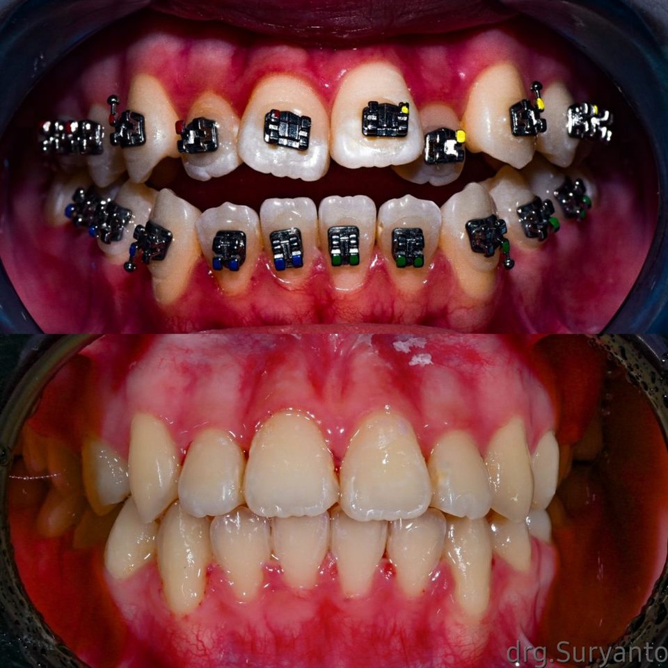 Kawat Gigi (Behel) hasil 26