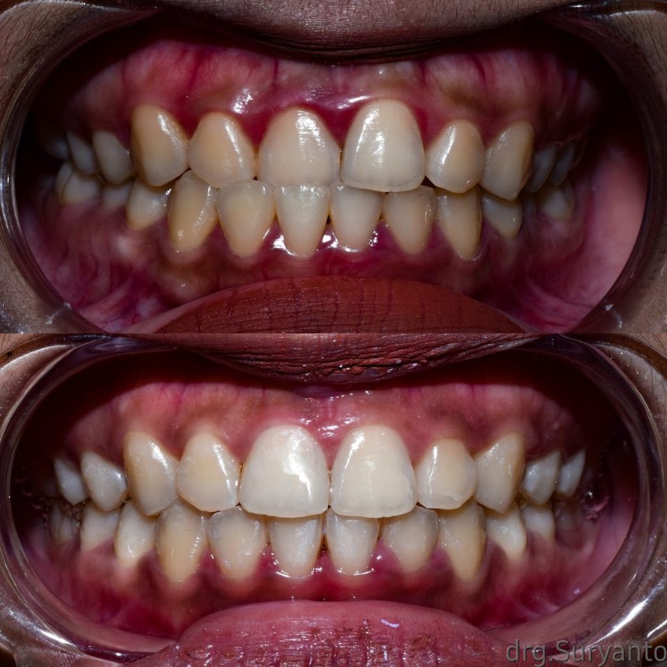 Kawat Gigi (Behel) hasil 27