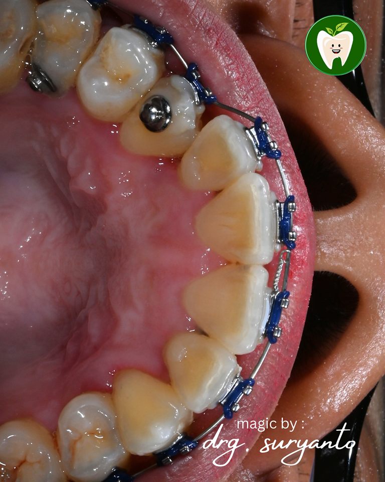 Kawat Gigi hasil 29