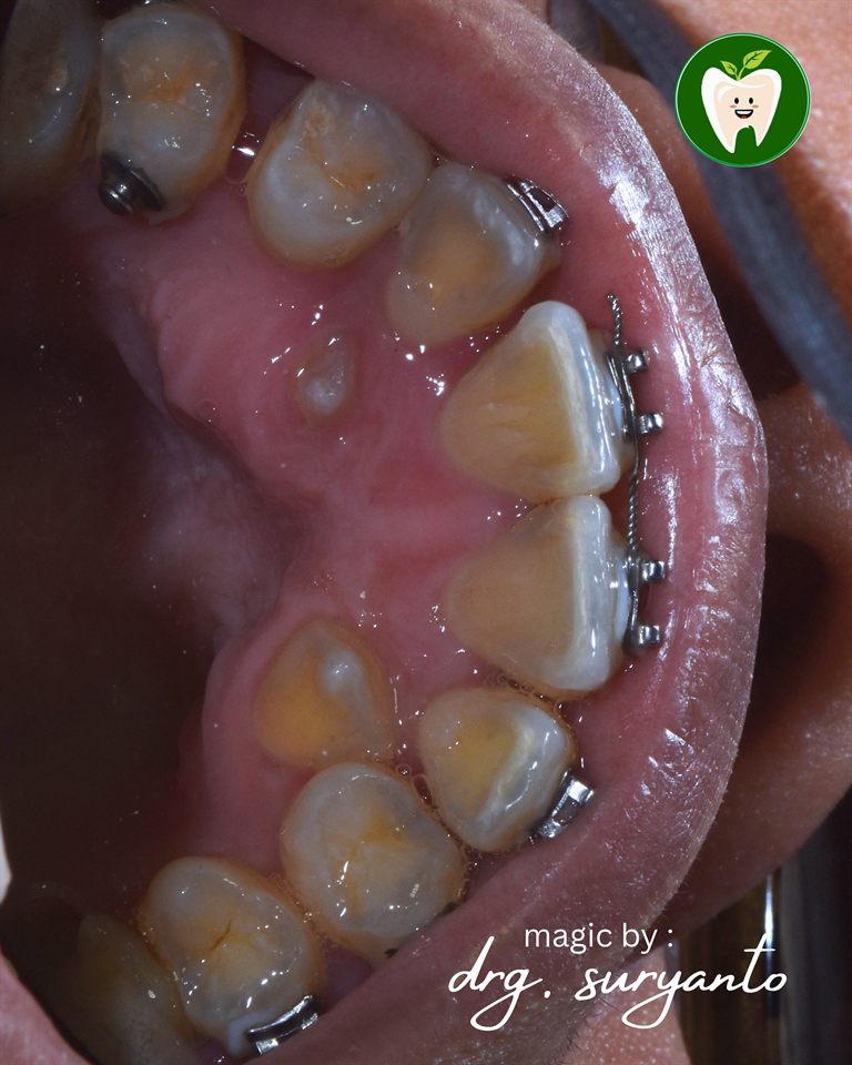 Kawat Gigi hasil 31