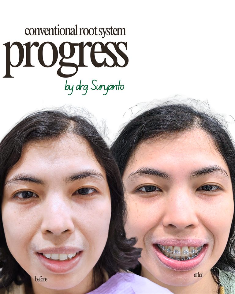 Kawat Gigi hasil 34