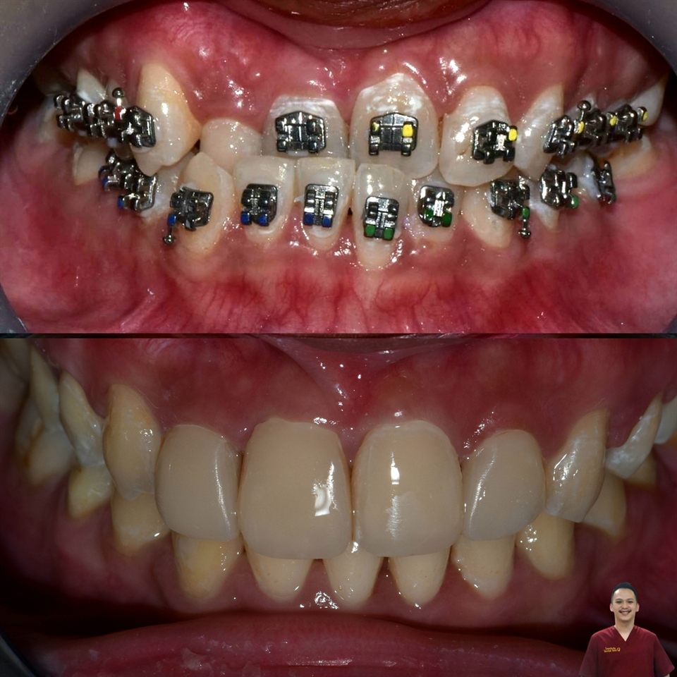 Kawat Gigi hasil 36