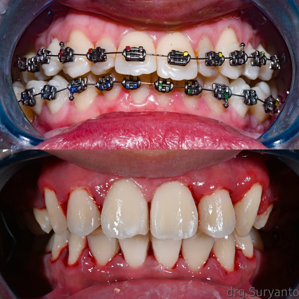 Kawat Gigi hasil 45