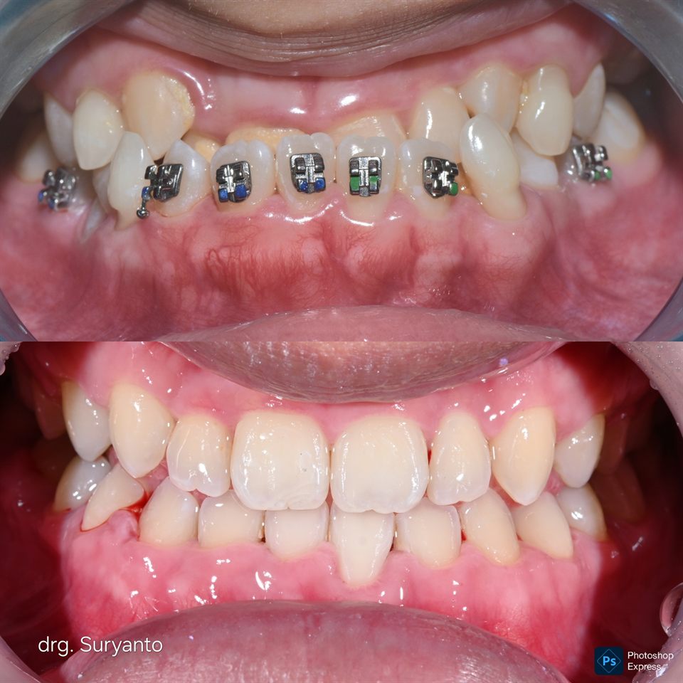 Kawat Gigi hasil 56