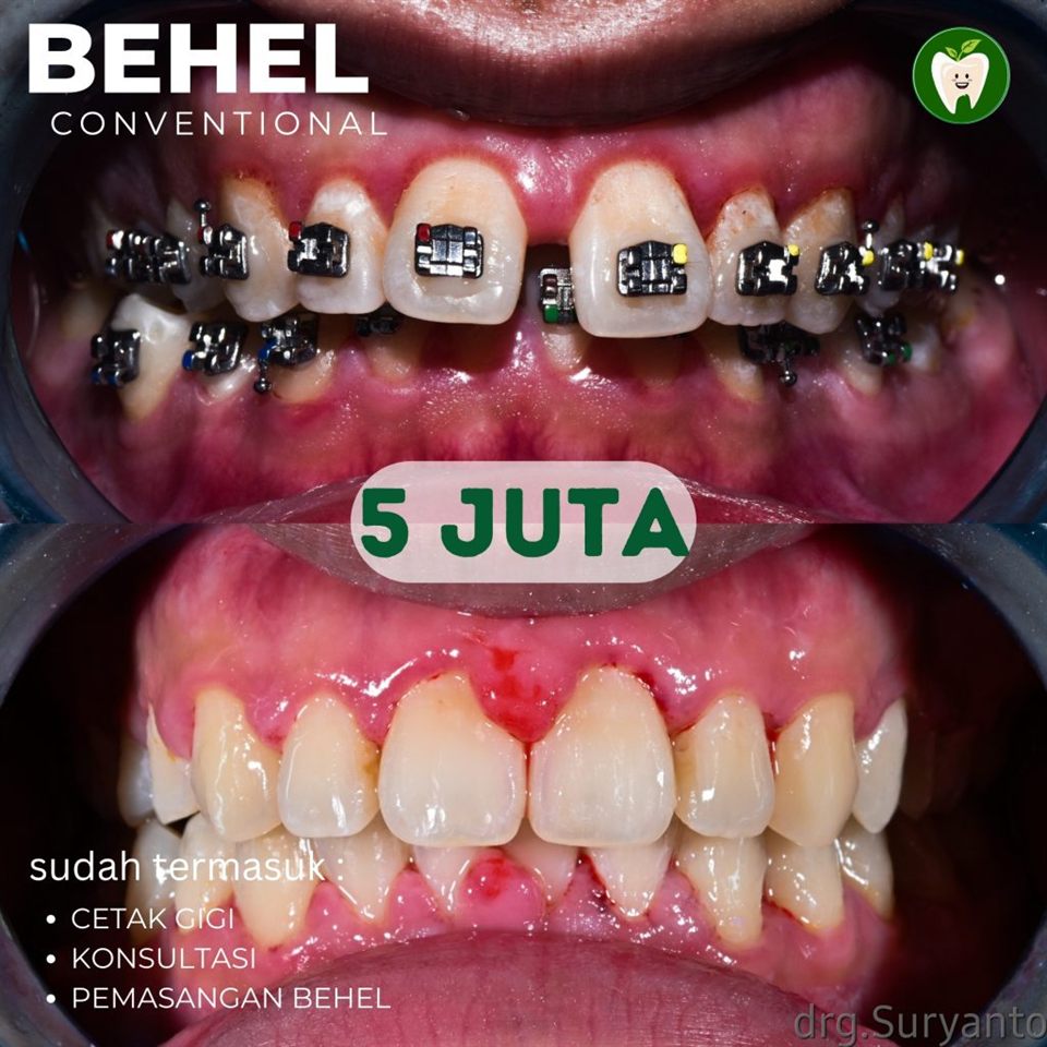 Kawat Gigi Metal USA - Cicilan 0% tanpa ribet