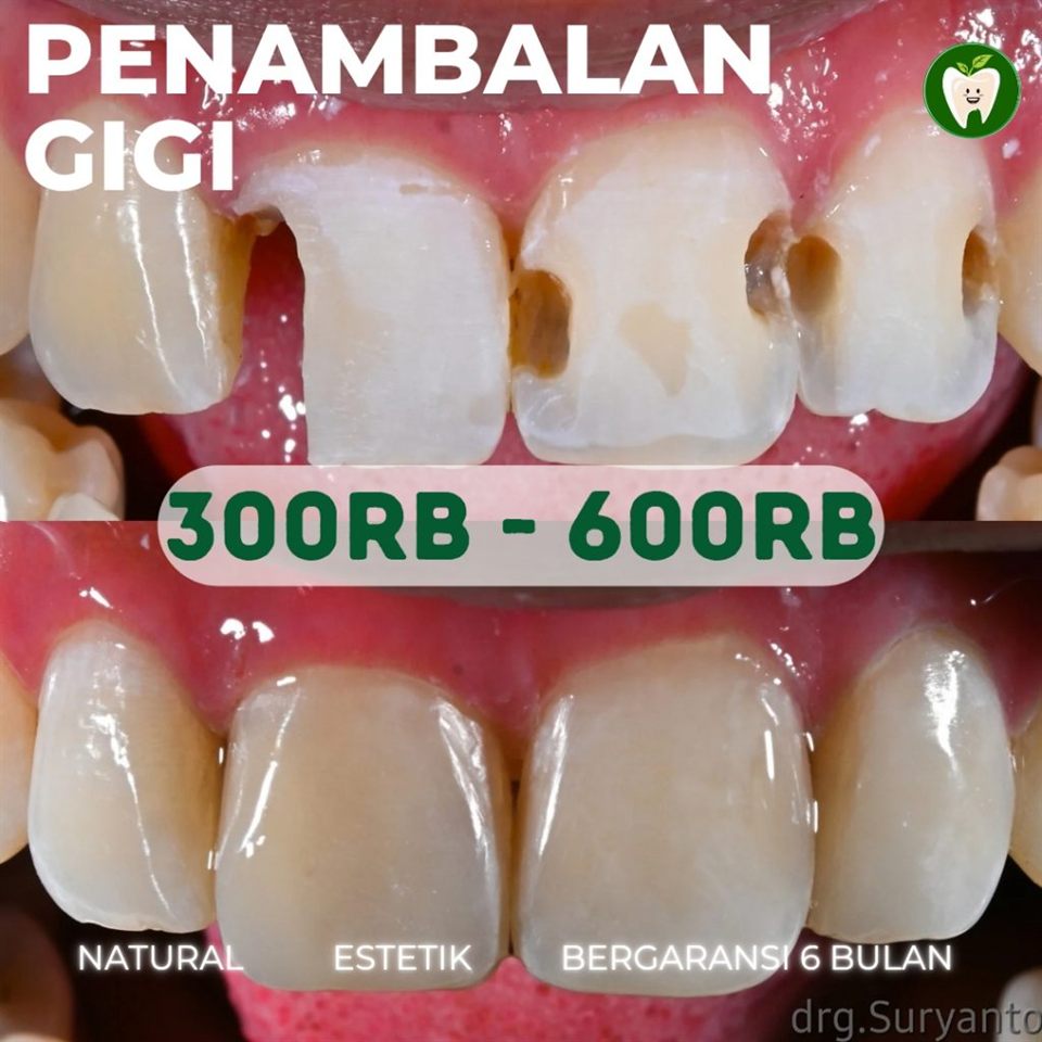 Penambalan Gigi - Bentuk dan Warna Seperti Asli & Bergaransi