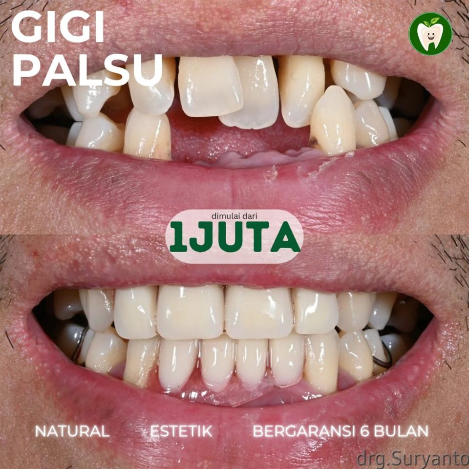 Gigi Palsu mulai dari 1 JT. Bergaransi 6 Bulan